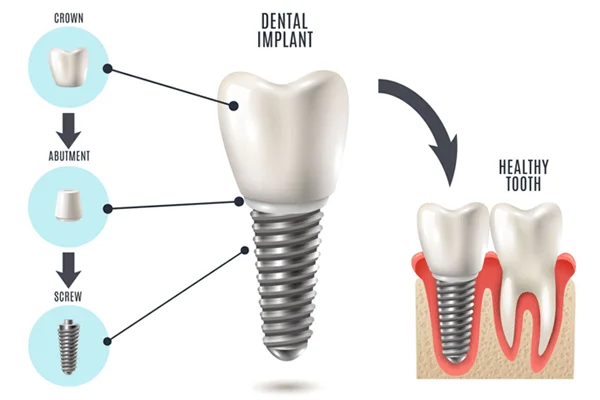 dental implant parts 1