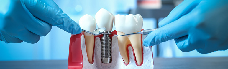 dental implants all