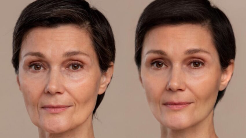 Dermal Fillers in Delhi Safe and Natural Facial Rejuvenation with Expert Care