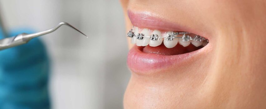 dental braces