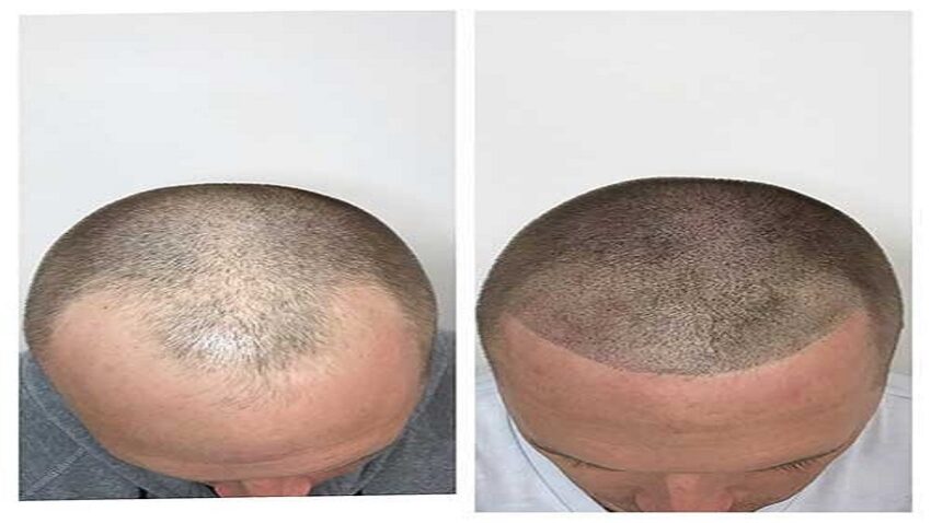Hair Thinning Treatment Vadodara