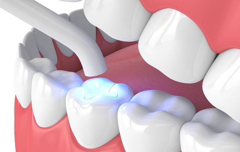 dental filling