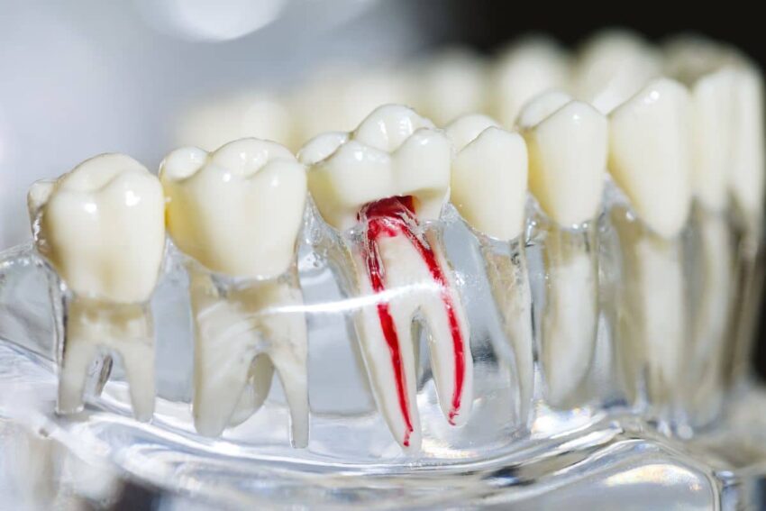 root canal treatment