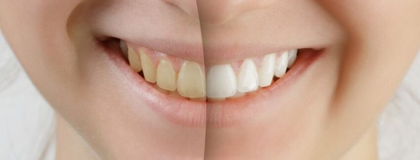 Teeth Whitening 1 1