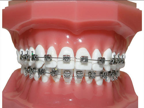 braces treatment 1