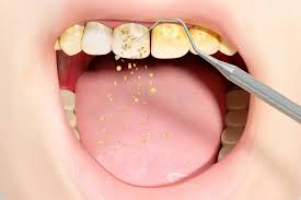 teeth cleniang1701