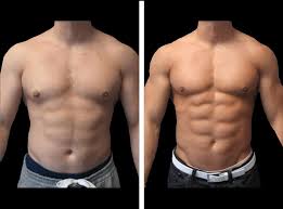 Male Liposuction in Dubai