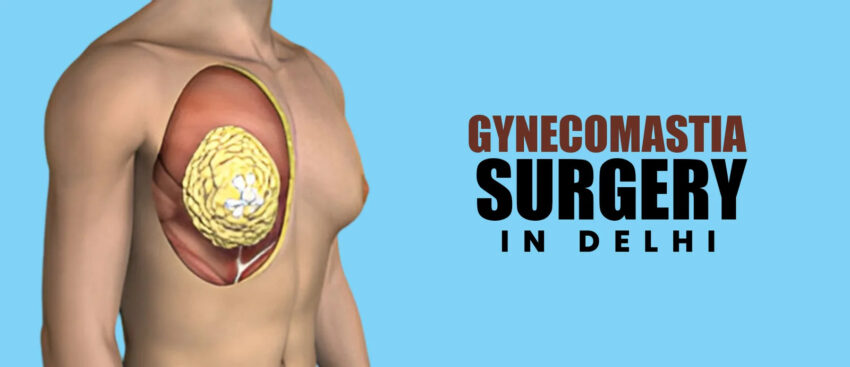 Gynecomastia Surgery in Delhi