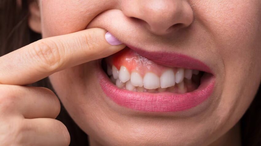 Gum Treatment 2