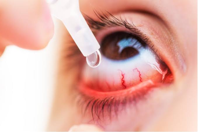 Eye allergy treatment in Fresno