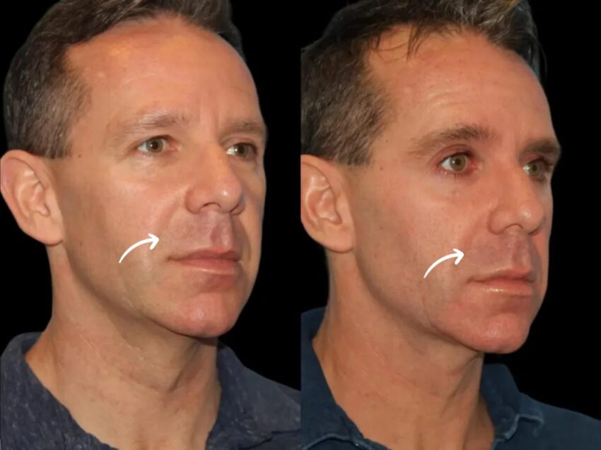 H6 Sculptra 1