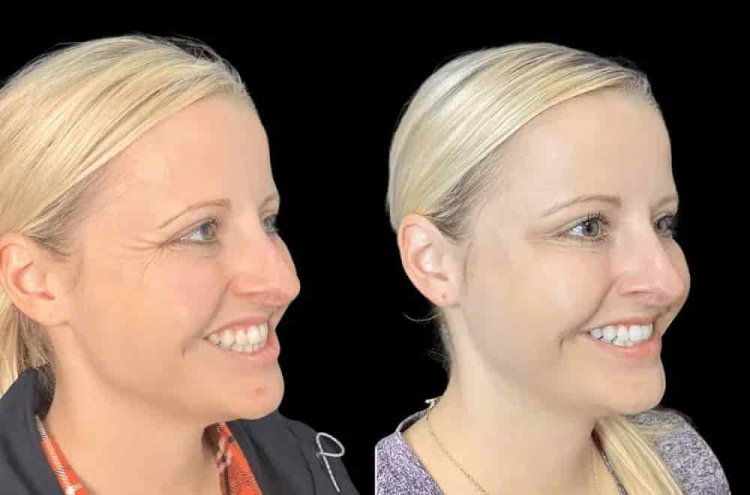 botox 1 min