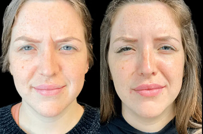 Botox in dubai 2