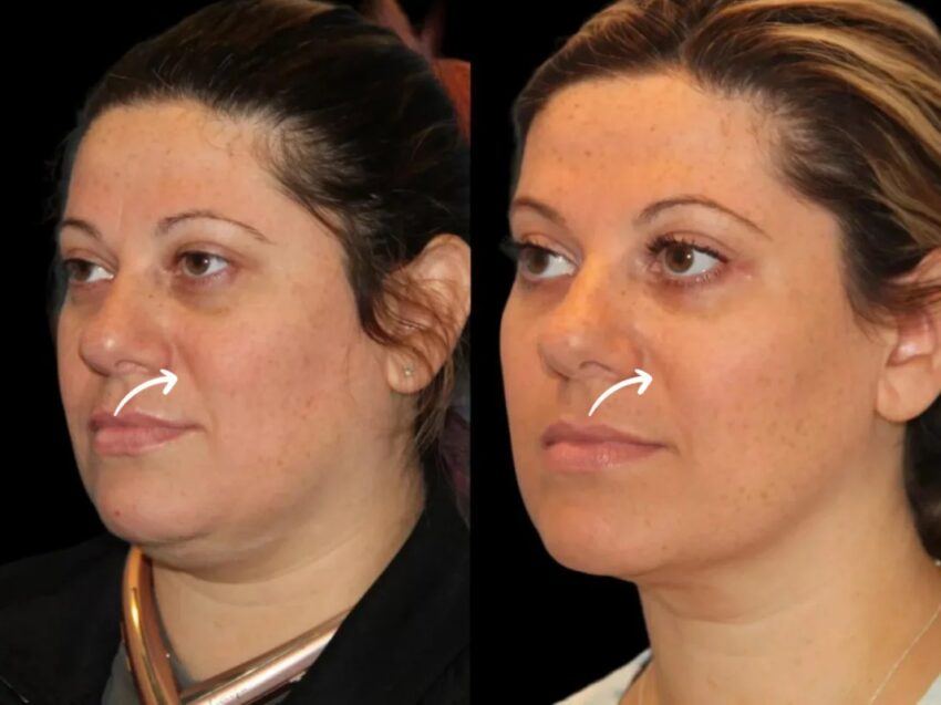 H7 Sculptra