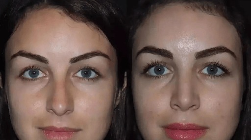 rhinoplasty 2