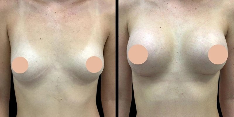 breast