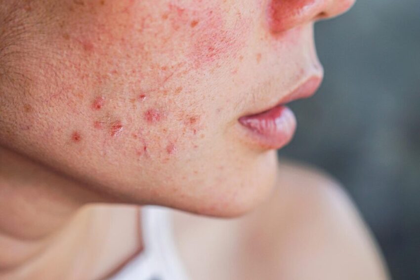 acne removal treatment dubai 1024x683 1