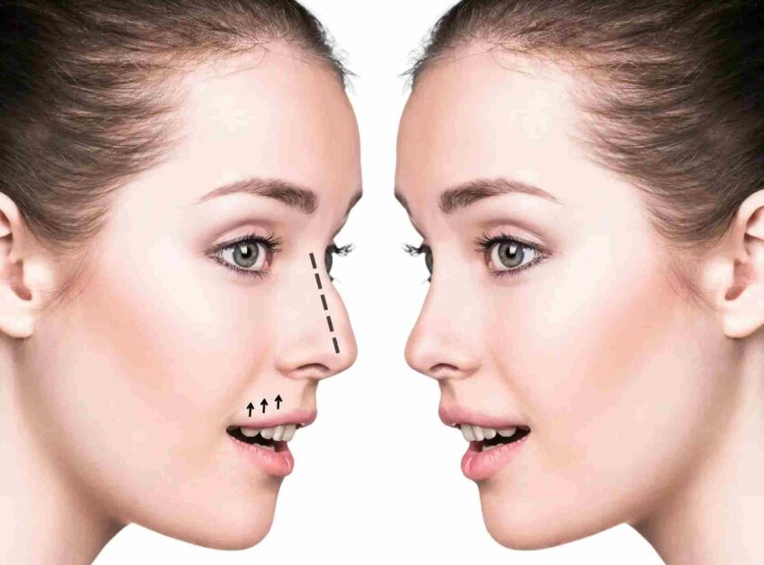 Rhinoplasty 11zon