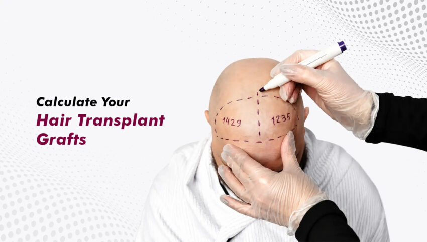 Calculate Your Hair Transplant Grafts1890 1071