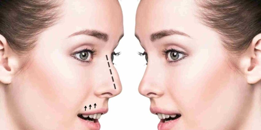 rhinoplasty in dubai 2