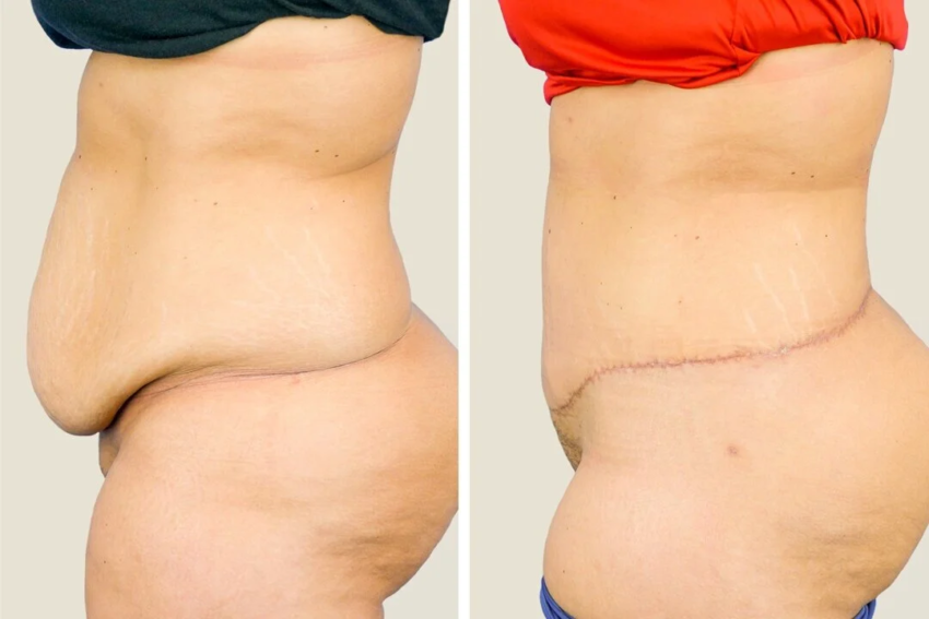 Liposuction B 1024