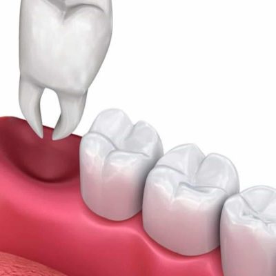 wisdom tooth extraction navi mumbai