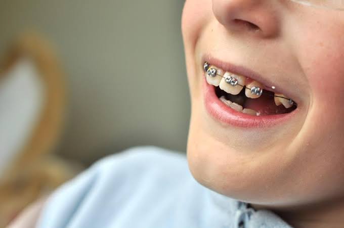 braces12