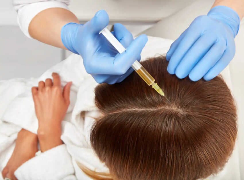 Benefits Of PRP Hair Restoration 1