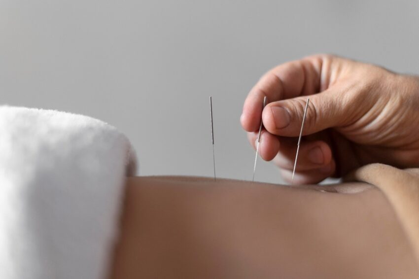 Acupuncture Treatment in Bryant Park