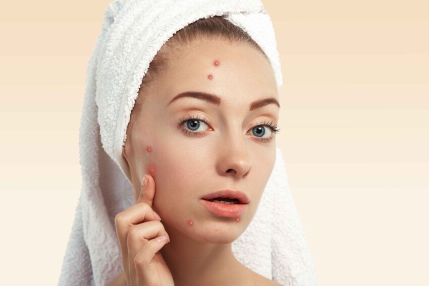 How Acne Scar Treatment Can Improve Skin Texture and Appearance