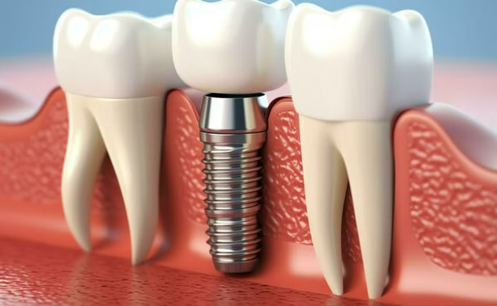 Dental Implant