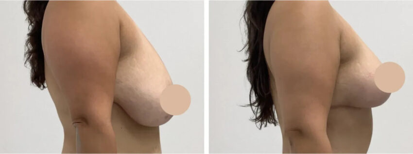 H12 Breast Lift