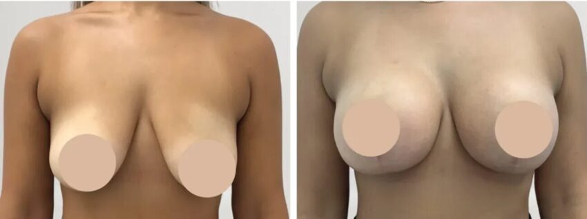 H1 Breast reduction