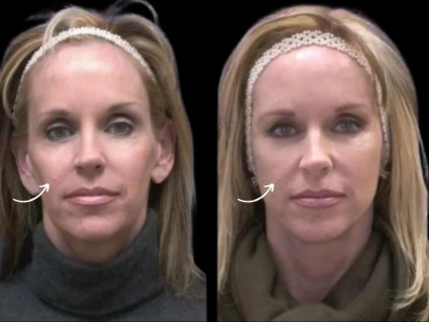 H15 Sculptra