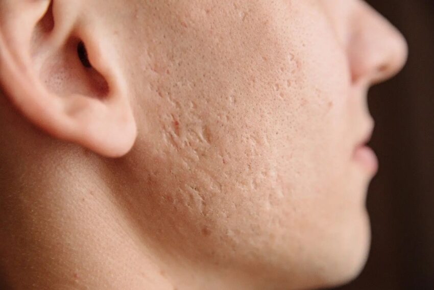 Acne Scar Treatment Hyderabad for Inform Clinics