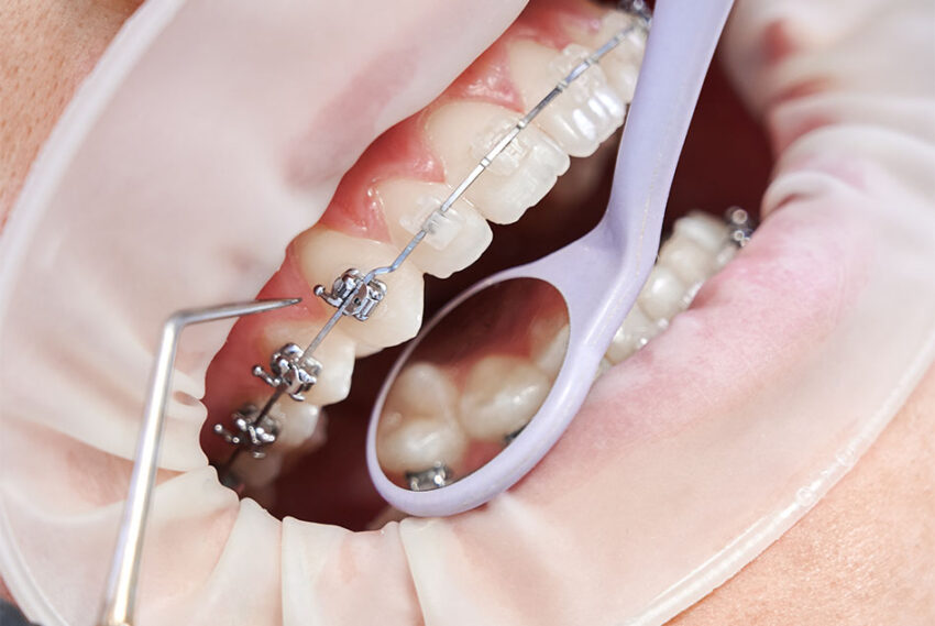 services 0016 orthodontic treatment 2