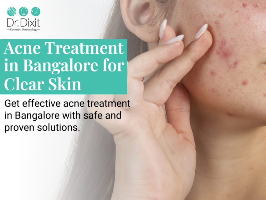 acne treatment in bangalore 4