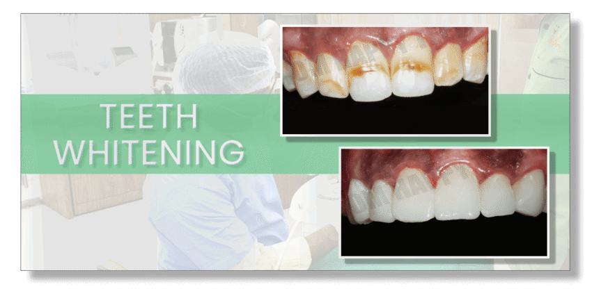 teeth whitening