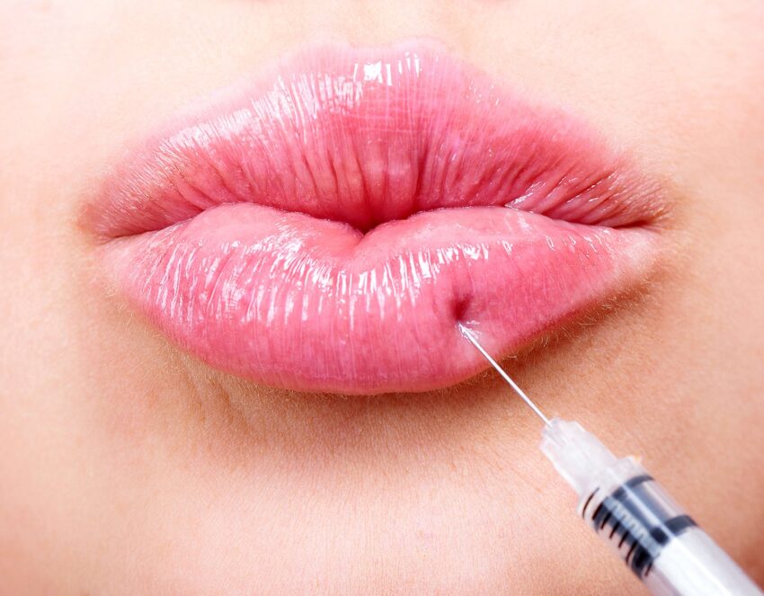 Russian Lip Fillers for Natural Looking Volume