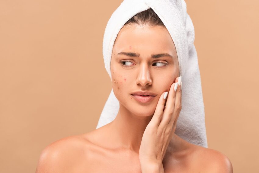 nude girl in towel touching face with acne and loo 2022 06 16 00 10 39 utc scaled 1