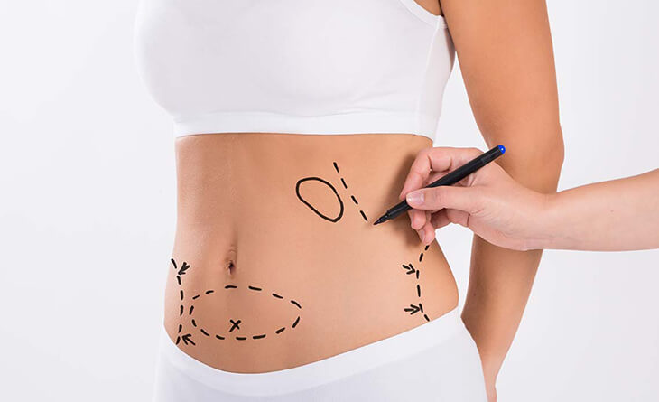 Lipoabdominoplasty Surgery IAAPS 02