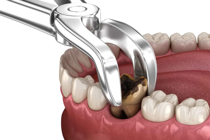 extraction of molar tooth damaged by decay 3d illustration 2 Original 2500x1667 1 1920x1280 2