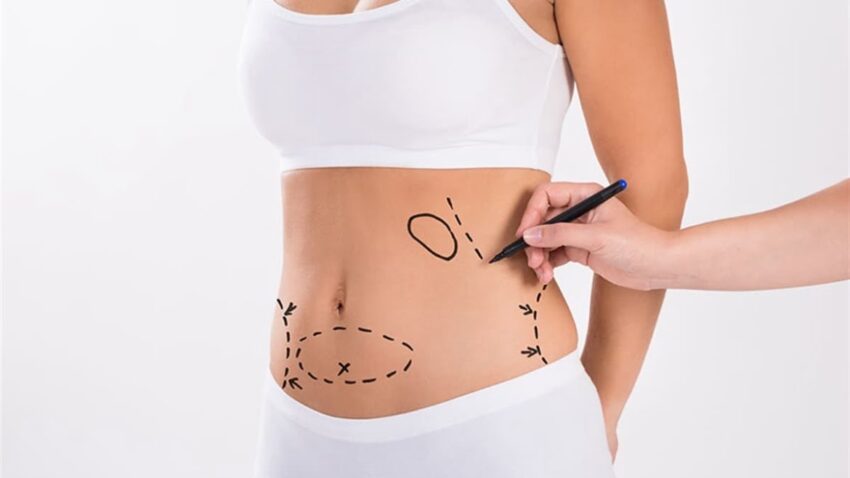 liposuction 68548 62647 b1 1170x658 1