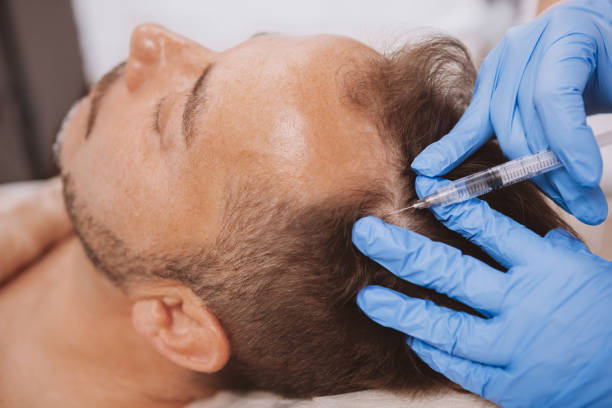 Is PRP Treatment Effective for Hair Loss