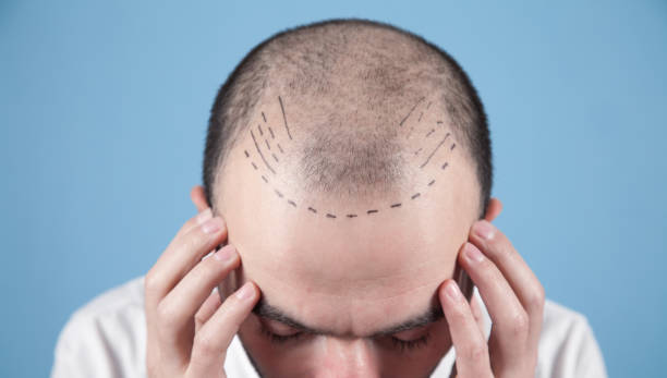 Is Hair Transplant suitable for different types of hair loss