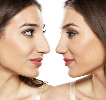 rhinoplasty 1