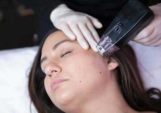 Does Morpheus8 Treatment Tighten Loose Skin