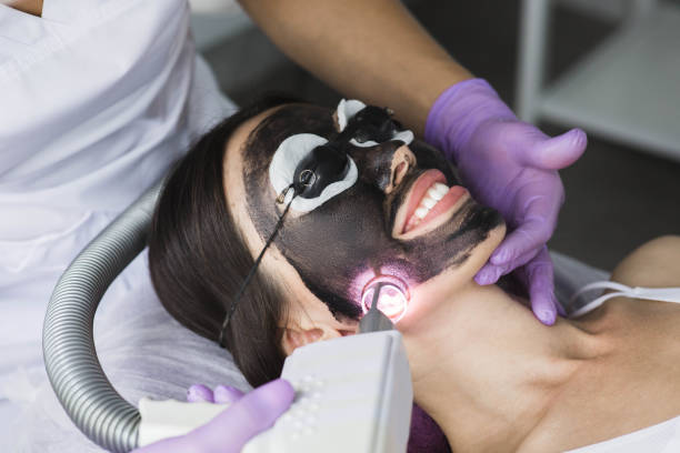 How can Laser Carbon Peel address tired skin
