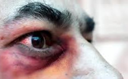 How Black Fungus Spreads and Environmental Risks