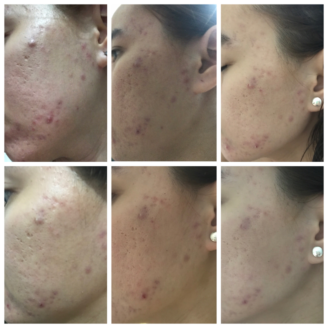 ac7 acne spot serum